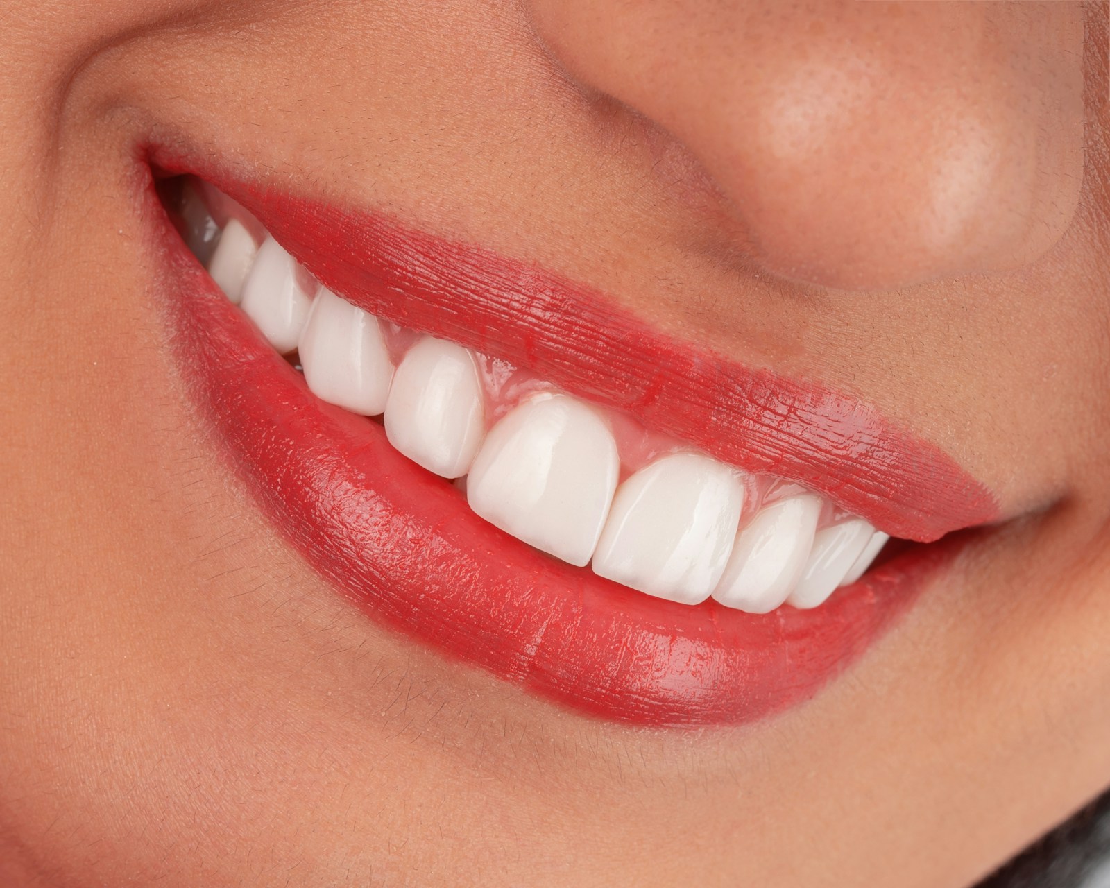 Sorriso com dentes brancos (depois — simulação)
